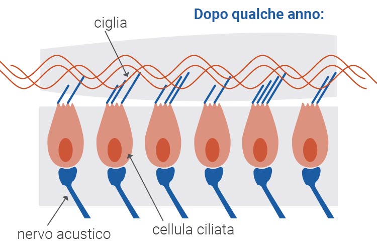 Cellula ciliata danneggiata